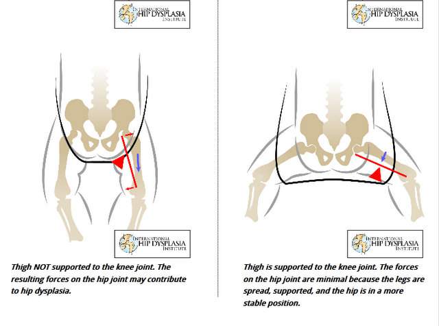 hip dysplasia baby carrier