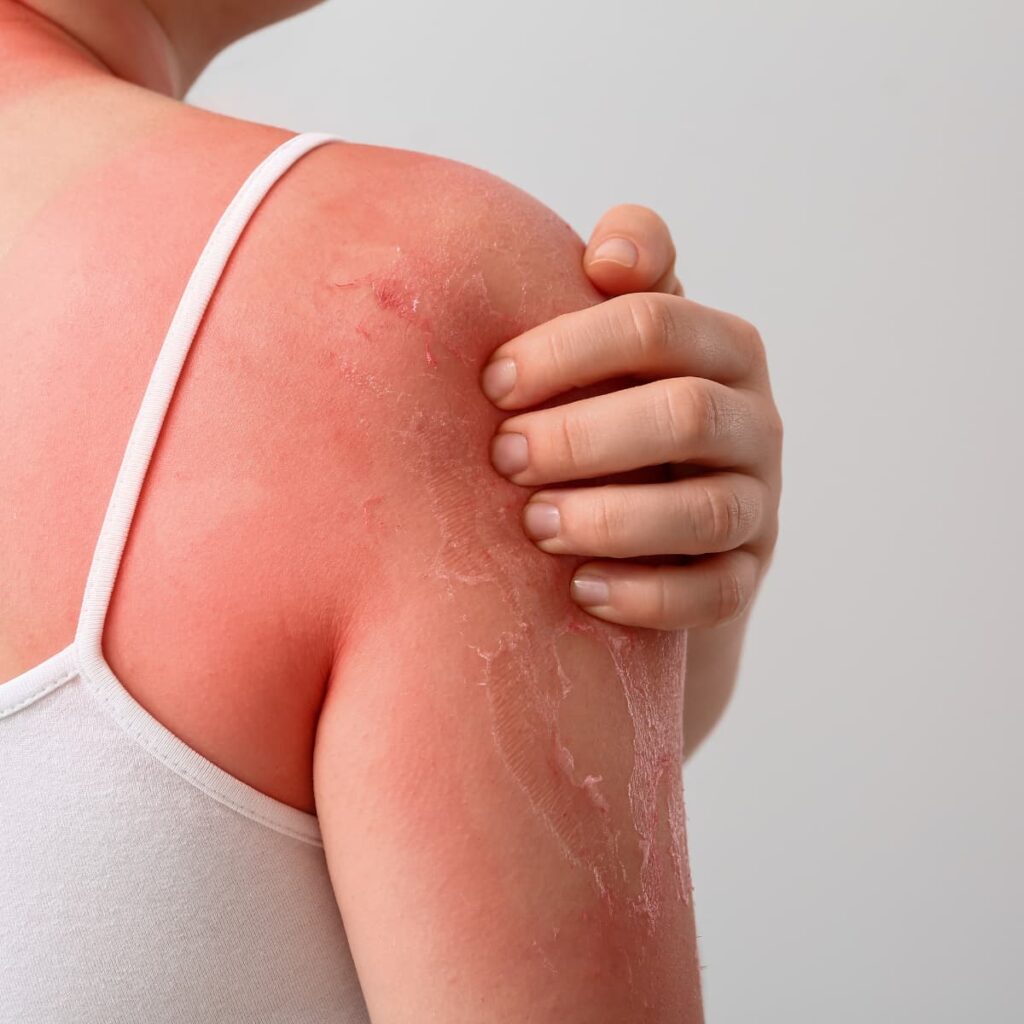 natural sunburn relief